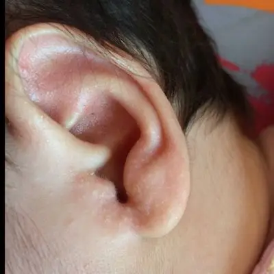 刚满月的宝宝 耳垂好多湿疹