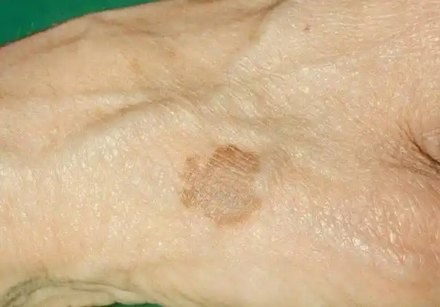 为何老人身上爱长斑?建议:50岁后远离五个习惯,或可减轻老年斑