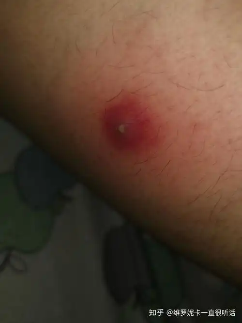后来腿上偶尔有痛感,发现有个小白点,还以为青春痘或者被虫子叮了一下