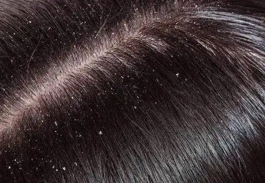 头皮痒痒痒!为什么?怎么办?|油性|水油_网易订阅