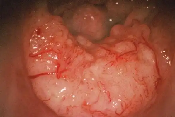 宫颈癌图片 (40)