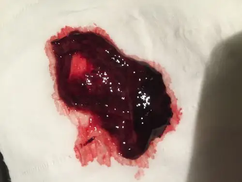 你好我40天药流这个是图片是流产成功了吗