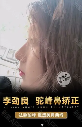 【驼峰鼻矫正】美鼻医生李劲良改善驼峰,重拾女人味
