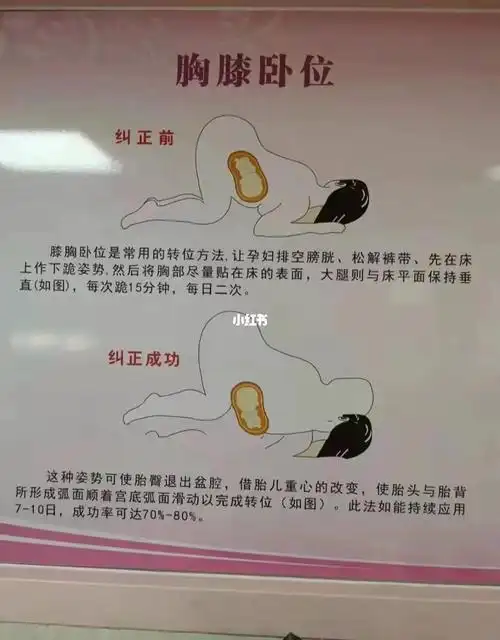 胎位不正,矫正方法