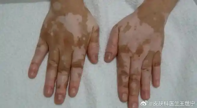 白癜风在皮肤一块块白斑,最容易造成大家的自卑心理,不愿面对外人!