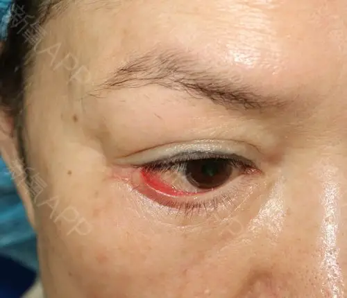 案例介绍该患者做了下眼睑除皱术造成眼睑下翻的失败后_圈子-新氧美容