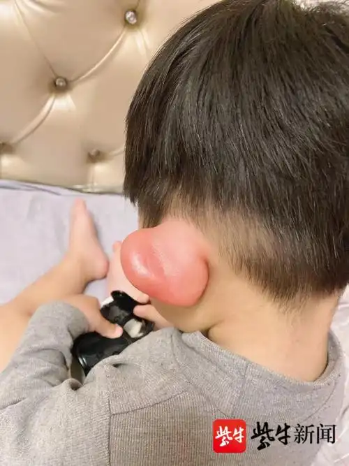 1岁萌娃耳朵被蚊虫叮咬后,肿成大耳朵图图 网友:既好笑又心疼