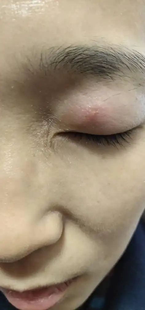 打击帮我看一下,我媳妇眼睛上起了一个痘痘都肿了,这到底怎么了?