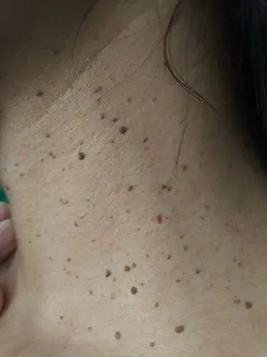 腋下起肉瘤是怎么回事(淋巴腋下有瘤有什么表现)