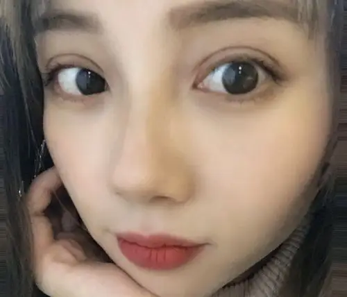 8mm平行双眼皮图片恢复