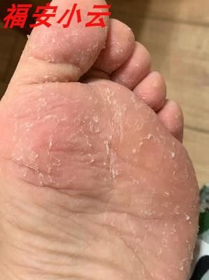 脚底板发白脚气【红】族人脚神医草本药膏脚汗臭痒脱皮水泡烂脚丫