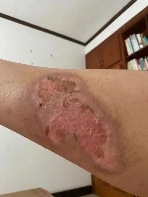 烫伤继过敏第二十八天