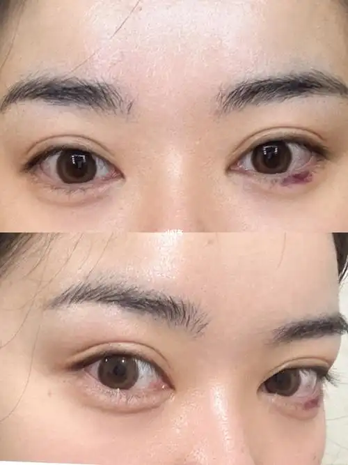 玻尿酸  鼓足了勇气填充卧蚕,用到的胶原蛋白 雅致.