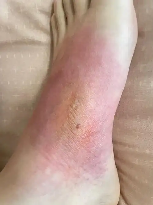 记录孕妇脚面开水烫伤恢复过程