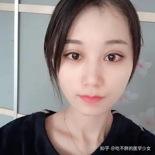 广州双眼皮成功案例,价格2w,恢复期间都有哪些需要注意的? - 知乎