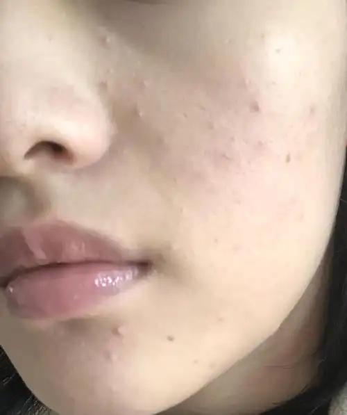 姐妹们这是闭口吗