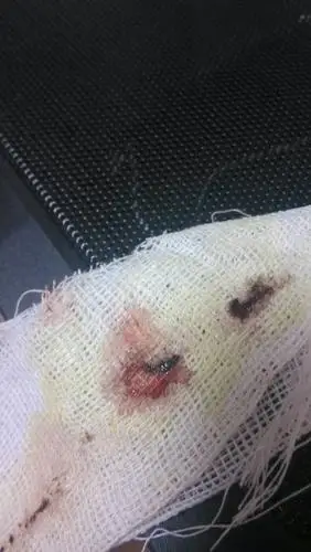 我做完包皮切除手术5天了!换药时发现包扎伤口的纱布上有血迹!