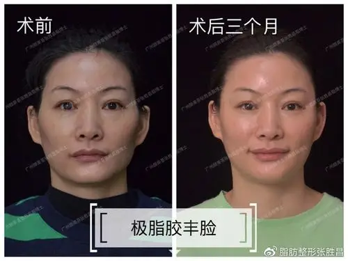 【脂肪填充全脸】:回家后,老公,邻居都看不出我做了自体脂肪填充