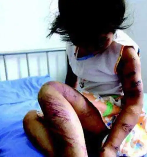 小苏丽是一名青海省西宁市的女童,因长期被亲生母亲燕志云所虐待,最后