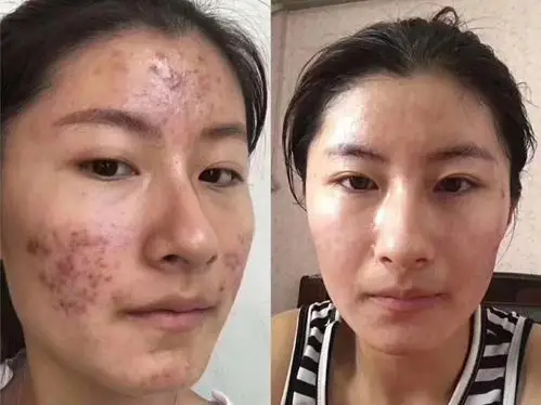 我的顾客痘痘妹,排毒前后对比照.
