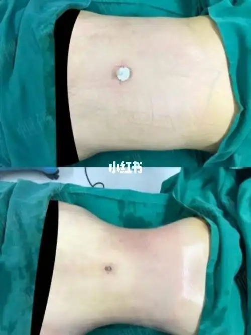 【威塑腰腹环吸】手术更自然,定位更准确:注重形状自然设计,使【威塑