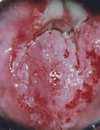 宫颈癌图片 (32)