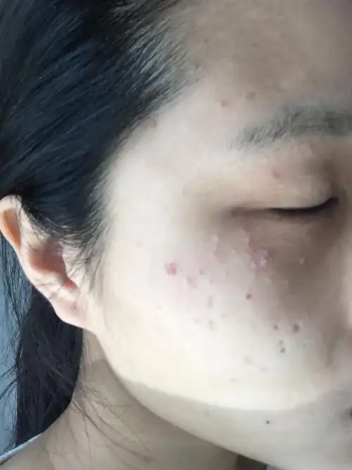 我的脸上突然长了很多这样的小肉点,一开始是在眼睛周围现在都慢慢的