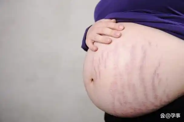 宝妈晒产后满是妊娠纹的肚子网友好吓人大多数都不是这样的