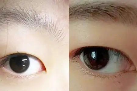 内双和单眼皮的区别图 教你拥有迷人大眼睛