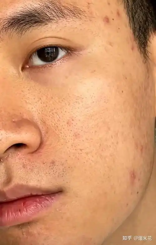 男生毛孔粗大黑头多出油长痘怎么办