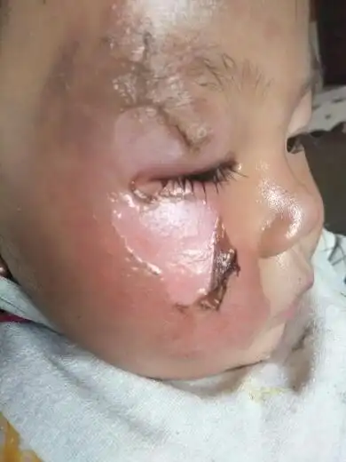 宝宝被火炉烫到面部
