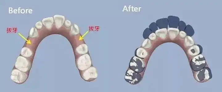 留了空位给暴出的门牙向内压平拔掉第一小臼齿例如这个案例空出调整的