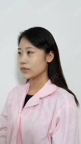 自体脂肪面部填充术后7天_面部填充术后7天_自体脂肪术后7天_泪已落下