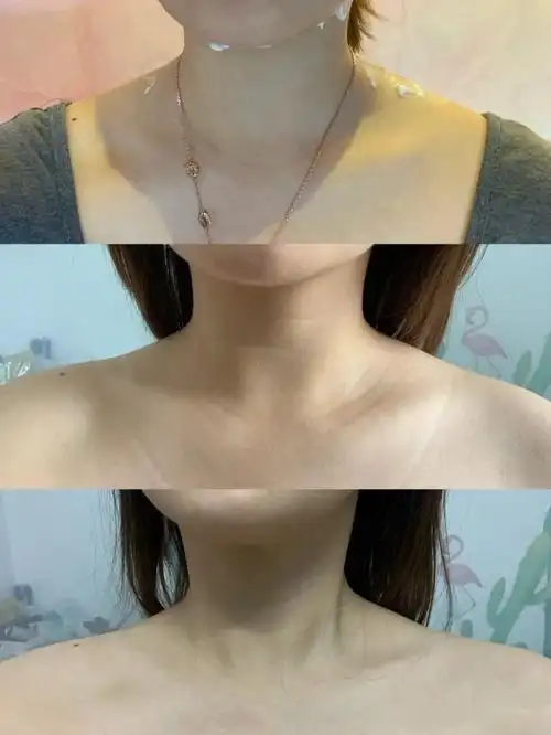 没打瘦肩针前,斜方肌真是太大了,很厚,虽然不胖,但_圈子-新氧美容整形