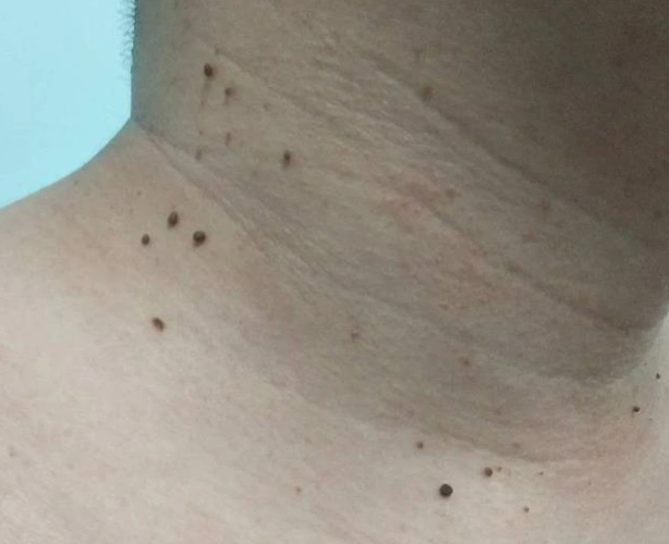 丝状疣反复发作怎么办_疣_介绍_治疗方式_日常注意事项 - 好大夫在线