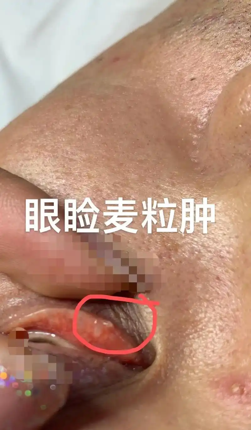 针尖麦粒肿取出 - 抖音