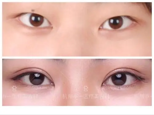 双眼皮术前术后对比图 - 好大夫在线