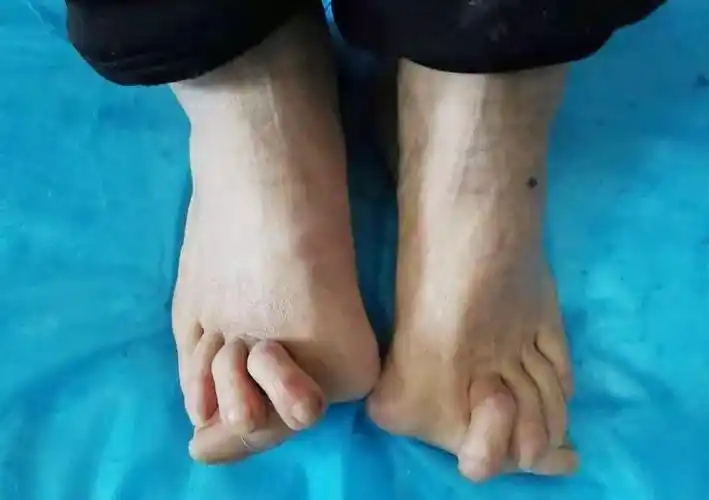 汤汤播报这样的大脚骨看着都疼