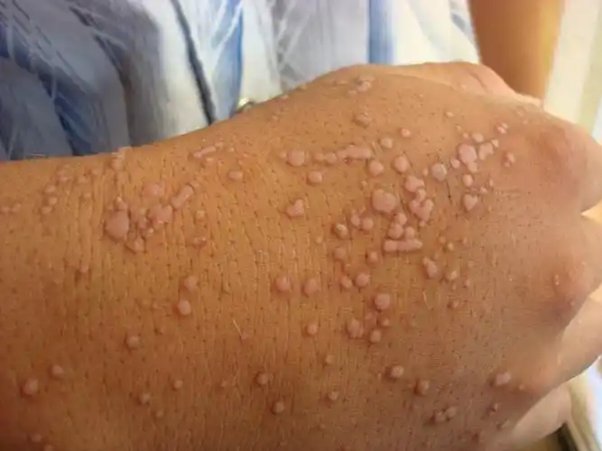 寻常疣_苏州乐桥皮肤专科,苏州医保定点皮肤病专科,苏州古城皮肤