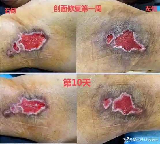 花了近2个w做的腋臭,最后却皮片全层坏死!启动创面修复.