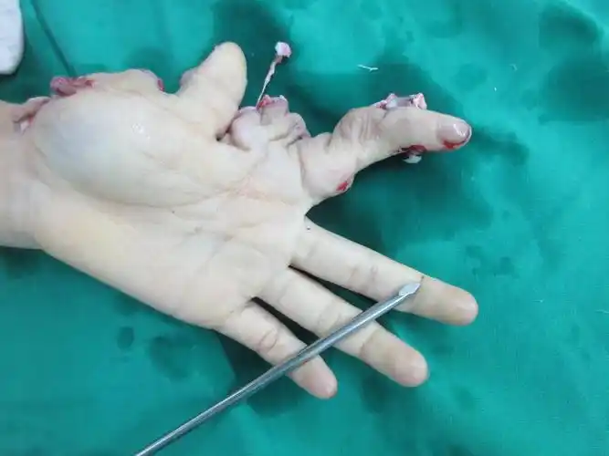 拇,示指Ⅶ缺损缺损 长手指再造