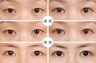 埋线双眼皮