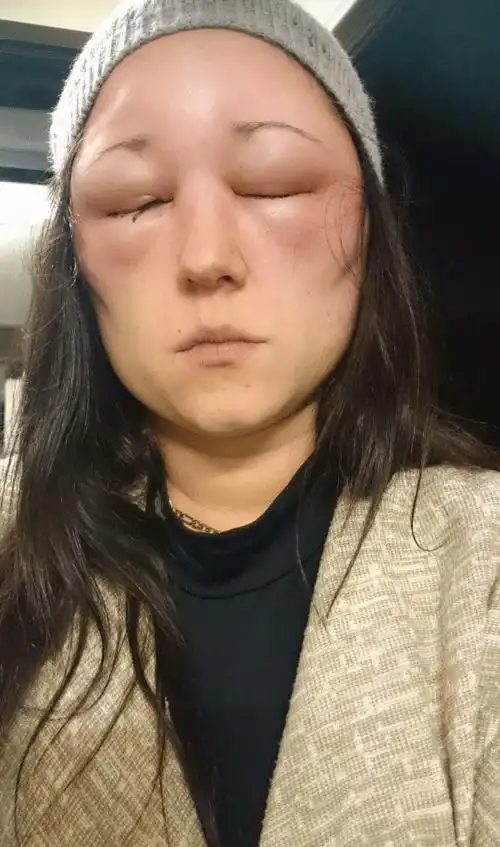 面部浮肿有免疫伤害引起的肾丝球肾炎及细菌感染有关的肾盂肾炎等