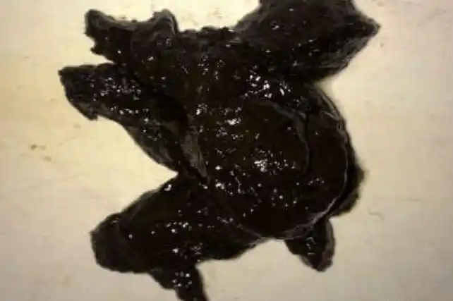 舒丽)排便是人体正常的生理现象,但是当拉出黑色大便时,不少人都会