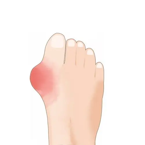 脚上肿块类风湿性关节炎骨头疼插画784230png图片素材