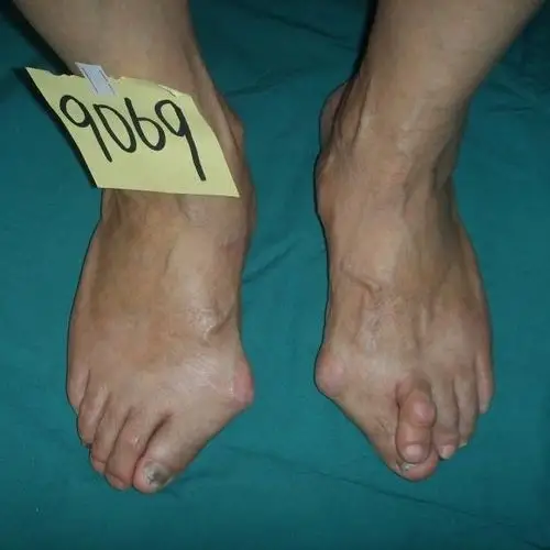 这是一个典型的严重大脚骨案例,她做完手术以后拆包扎的样子
