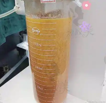 成都面部脂肪填充有推荐好的医院和医生吗邓萌唐勇