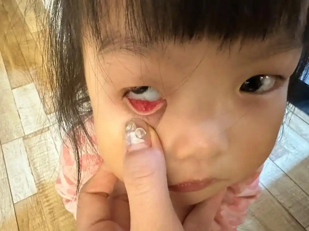 霰粒肿麦粒肿 #霰粒肿 霰粒肿一般不会自己消退 七 - 抖音