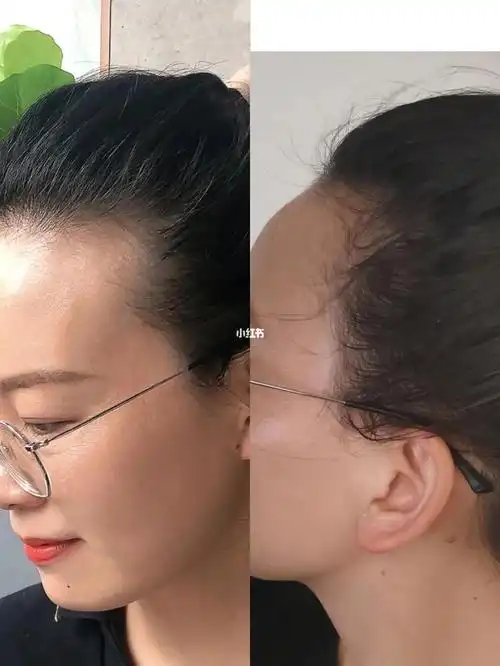 发际线额角填充大法