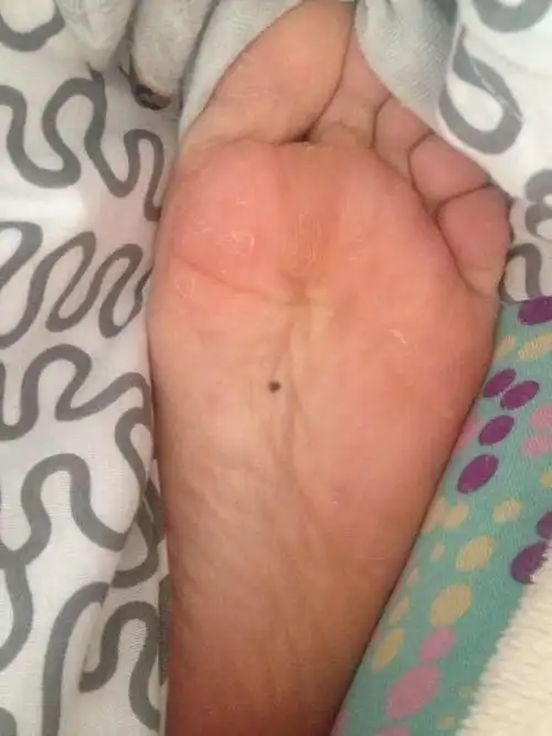 27岁女以前都没有发现脚底有黑点的